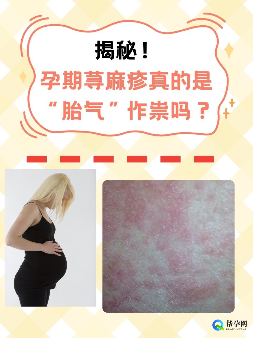 揭秘！孕期荨麻疹真的是“胎气”作祟吗？